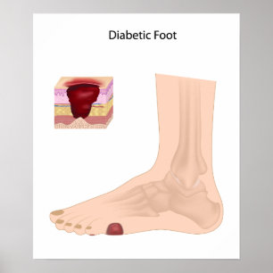 Diabetesfot Poster