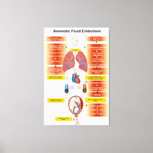 Diagram av en fosterhinne- Fluid blodpropp AFE Canvastryck