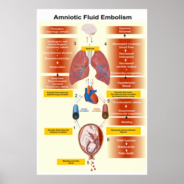 Diagram över amniotisk vätskembolism (AFE) Poster (Framsidan)