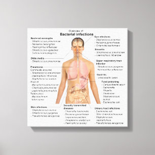 Diagram över bakterieinfektioner hos människor  canvastryck