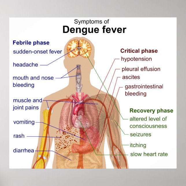 Diagram över de huvudsakliga symtomen på Denguefeb Poster (Framsidan)