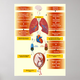 Diagram över en amniotisk vätskembolism poster