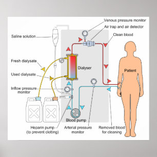 Diagram över medicinsk behandling vid hemodialys poster