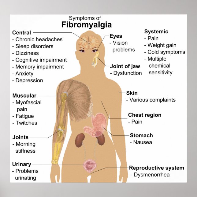 Diagram över symptom på fibromyalgi poster (Framsidan)