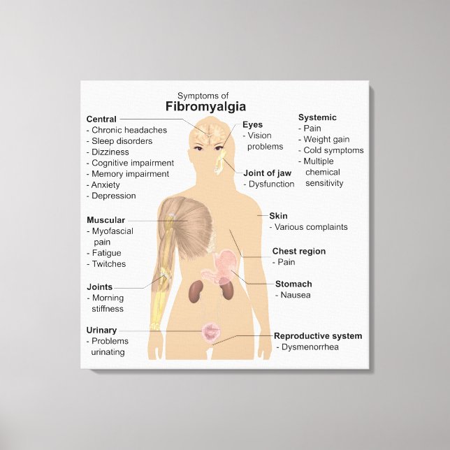 Diagram tecken symtom fibromyalgi canvastryck (Framsida)