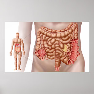 Diverticulit i den avtagande kolonregionen poster