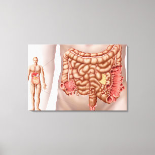 Diverticulitis i regionen för nedgÃ¥ende kolon Canvastryck