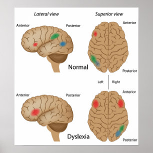 Dyslexia hjärnaktivitet Poster