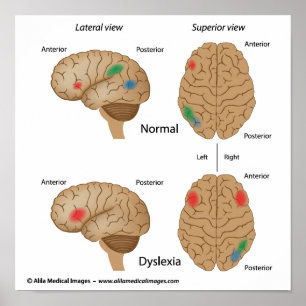 Dyslexia hjärnaktivitet Poster