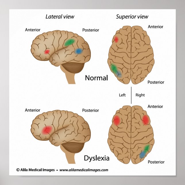 Dyslexia hjärnaktivitet Poster (Framsidan)