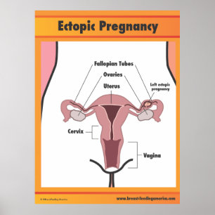 Ectopic-Gravid Poster