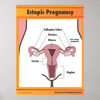 Ectopic-Gravid Poster