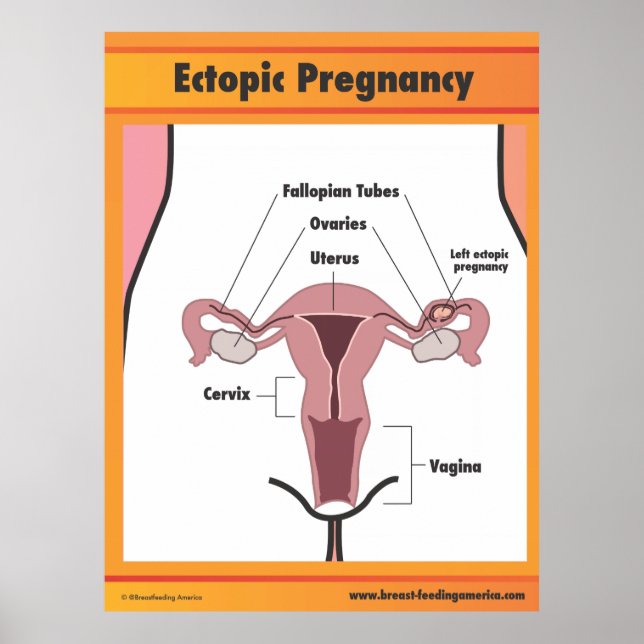 Ectopic-Gravid Poster (Framsidan)