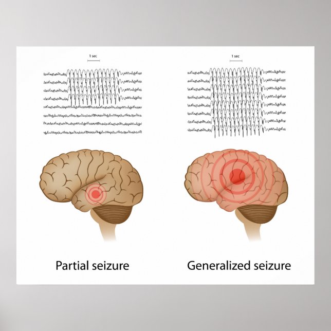 EEG vid partiell och generaliserad epilepsiPoster Poster (Framsidan)
