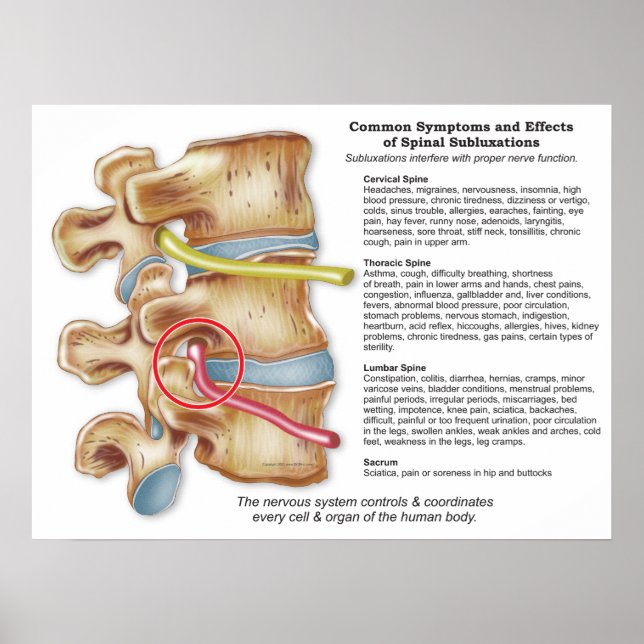 Effekter av spinalsubluxation Chiropraktik Poster (Framsidan)