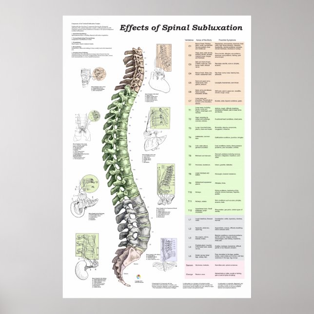 Effekter av spinalsubluxation Poster frossa (Framsidan)