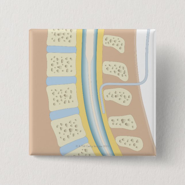 Epidural anestesi knapp (Framsida)