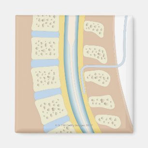 Epidural anestesi magnet