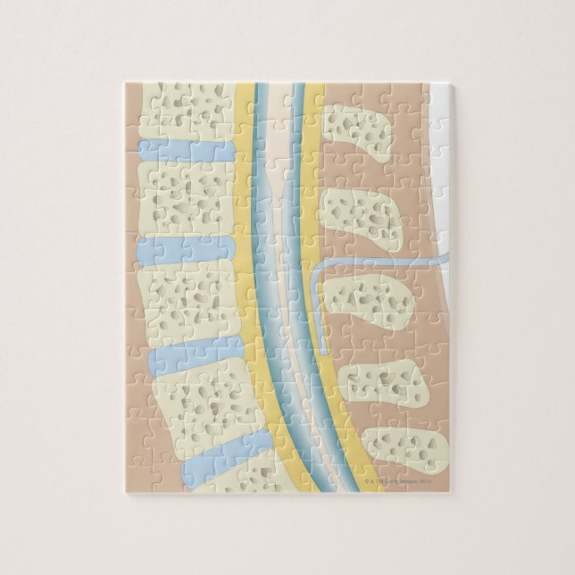 Epidural anestesi pussel (Vertikal)