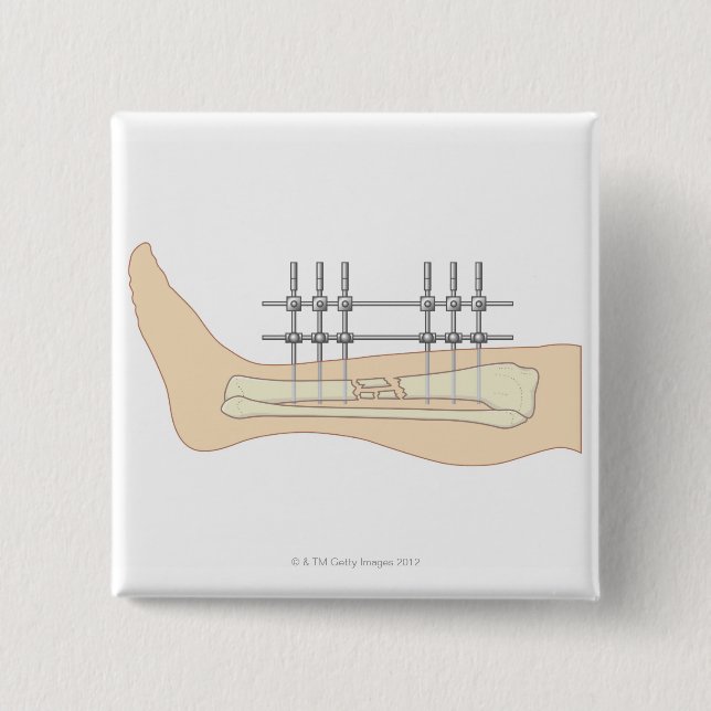 Extern fixator knapp (Framsida)