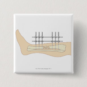 Extern fixator knapp