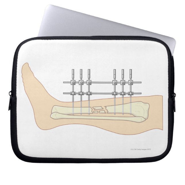 Extern fixator laptop sleeve (Framsidan)