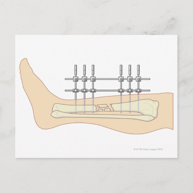 Extern fixator vykort (Framsida)