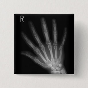 Extra Digit X-ray Höger Hand Knapp