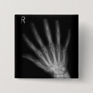 Extra Digit X-ray Höger Hand Knapp