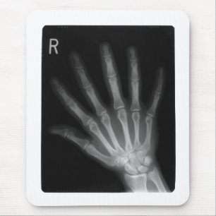 Extra Digit X-ray Höger Hand Musmatta