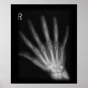 Extra Digit X-ray Höger Hand Poster