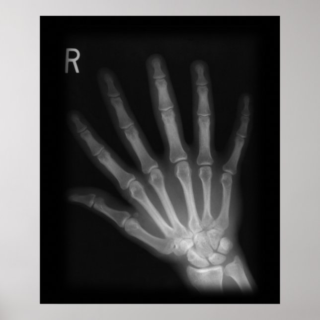 Extra Digit X-ray Höger Hand Poster (Framsidan)