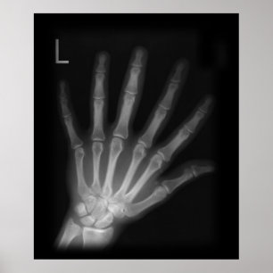 Extra Digit X-ray Lämnat hand Poster
