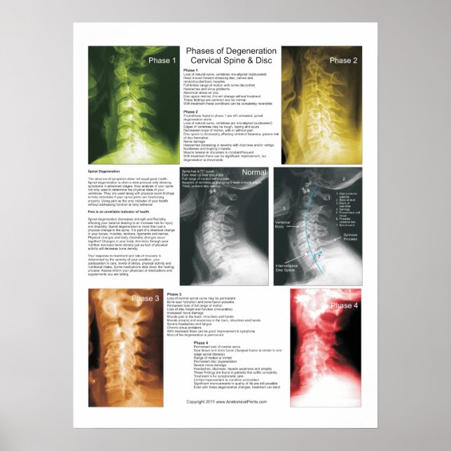 Faser Cervical Spinal Degeneration Poster (Framsidan)