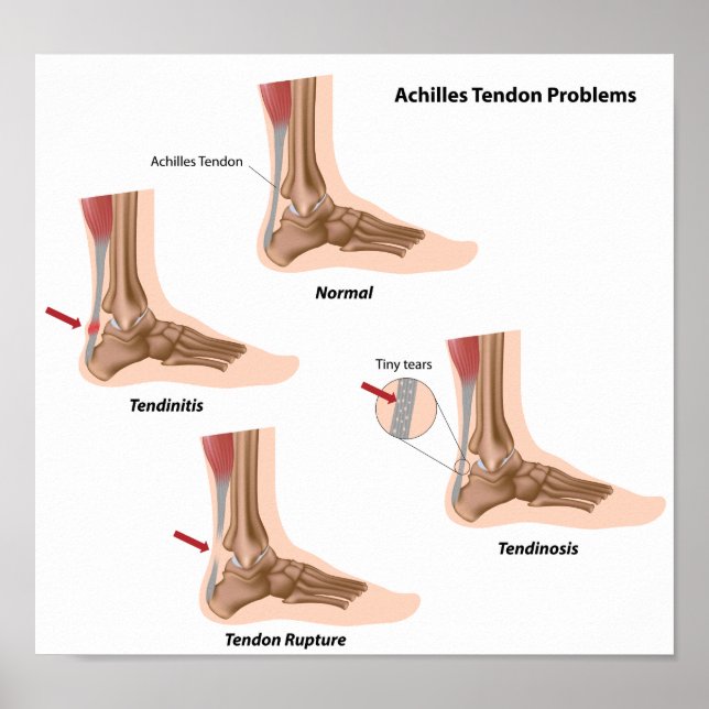 Fettsmärtor Achilles senon-problem Poster (Framsidan)