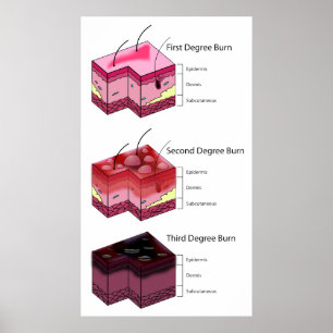 Flå brännskadan understöder först & diagrammet poster