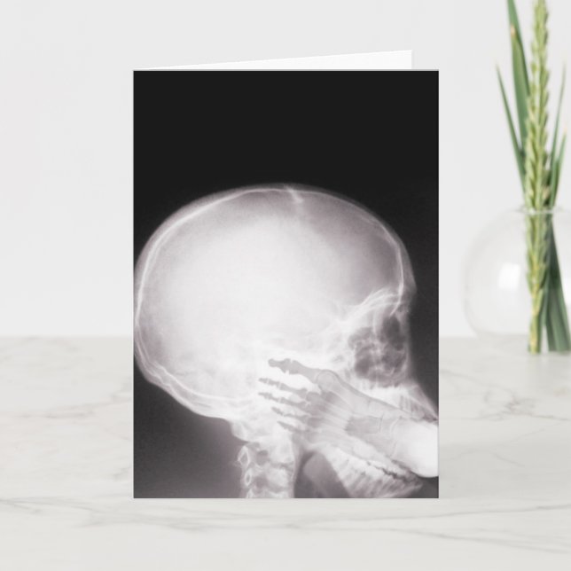 Foot i munnen X-Ray Kort (Framsida)