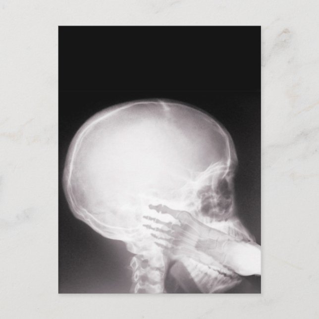 Foot i munnen X-Ray Vykort (Framsida)