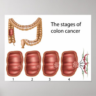 Förlopp av koloncancer Poster