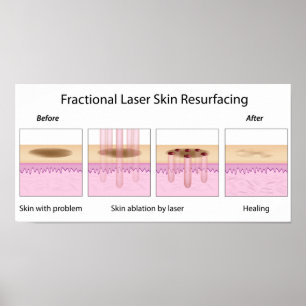 Fractional Laser Skin Resurface Poster