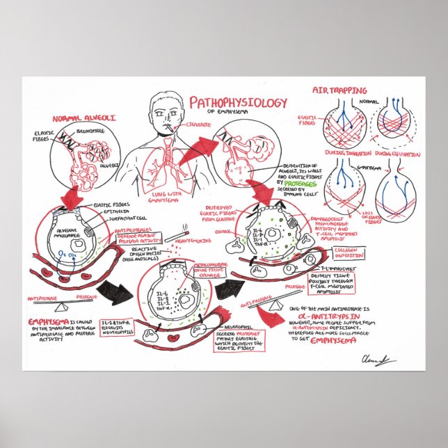 Fysiologi för Emphysema Poster (Framsidan)