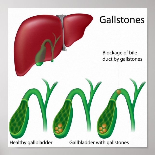 Gallstones och Poster lever (Framsidan)