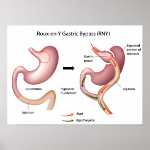Gastric kirurgiaffisch för förbikoppling Roux-en-y Poster