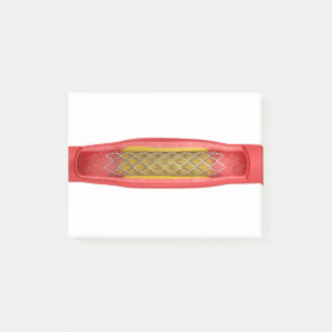 gioplastik med stent placering post-it block