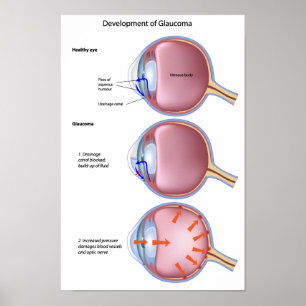 Glaucoma Poster öga