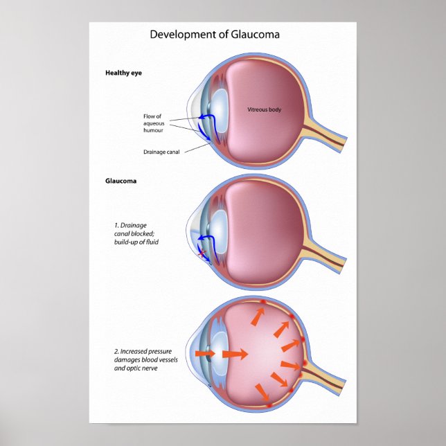 Glaucoma Poster öga (Framsidan)