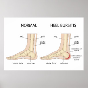 Haglunds deformitet poster