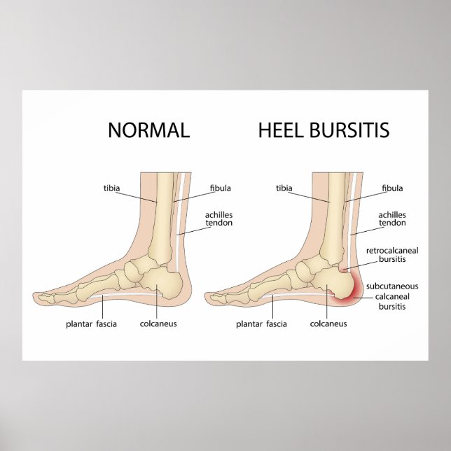 Haglunds deformitet poster (Framsidan)