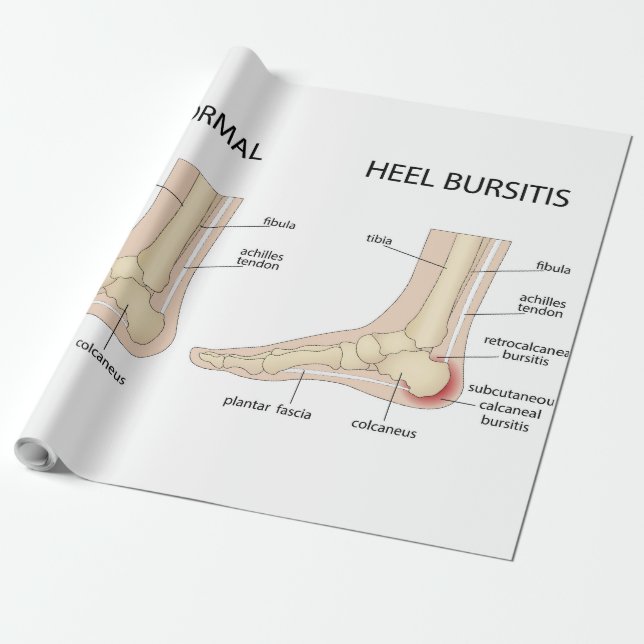 Haglunds deformitet presentpapper (Utrullad)