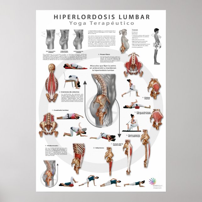 Hiperlordosis - definición, causas y tratamiento poster (Framsidan)